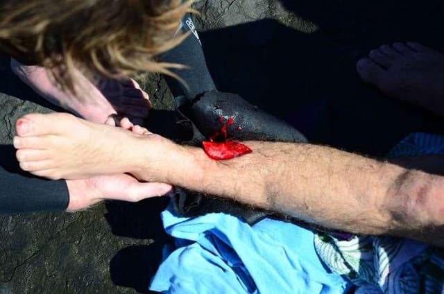 wade goodall broken tibia